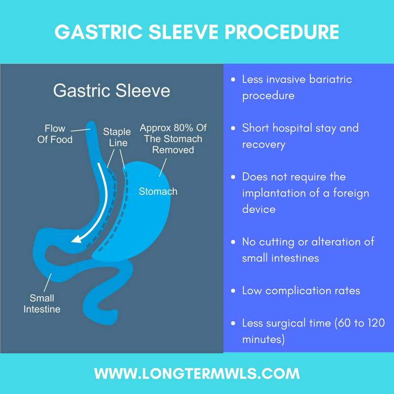 Long Term WLS / VSG | Gastric Sleeve Surgery - Dr. Jorge ...