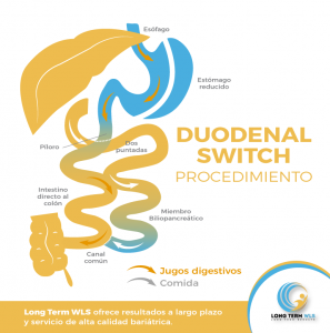 wp content uploads 2018 09 Duodenal Switch ES 1 297x300.png