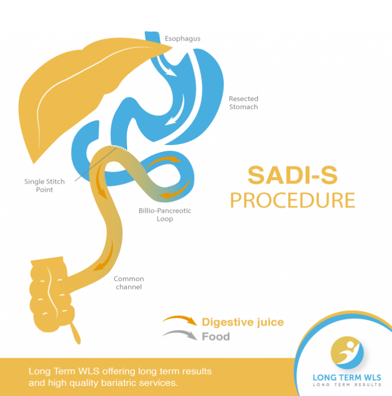 SADI-S Bariatric Surgery, In Tijuana Mexico - Long Term WLS / VSG