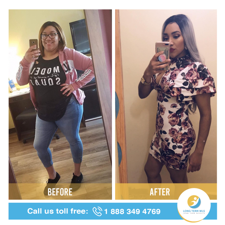 About Long Term WLS / VSG Weight loss surgery in Mexico