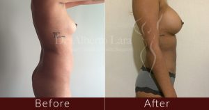 wp content uploads 2018 01 breast augmentation and liposuction1 300x158.jpg