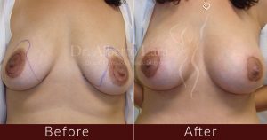 wp content uploads 2018 01 breast augmentation7 300x158.jpg