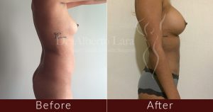 wp content uploads 2018 02 breast augmentation and liposuction1 300x158.jpg