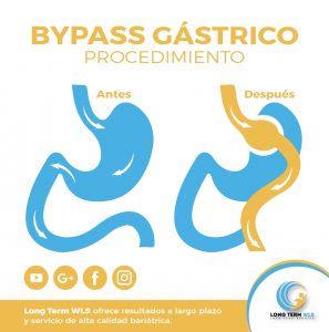 wp content uploads 2018 09 Bypass Gástrico 1 297x300.png