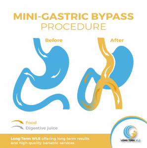 wp content uploads 2018 09 Mini Gastric Bypass 1 297x300.png
