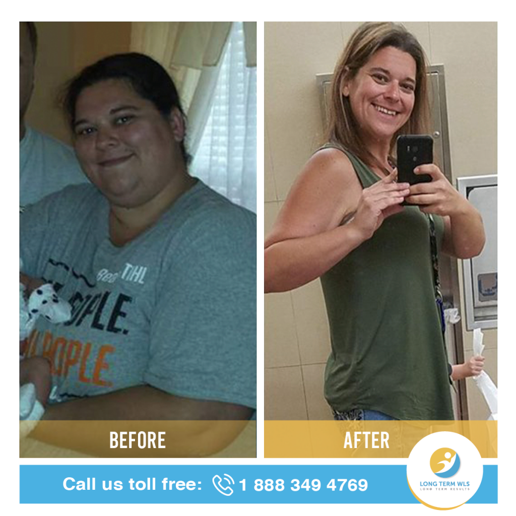 WLS Before and After Pictures Long Term WLS / VSG