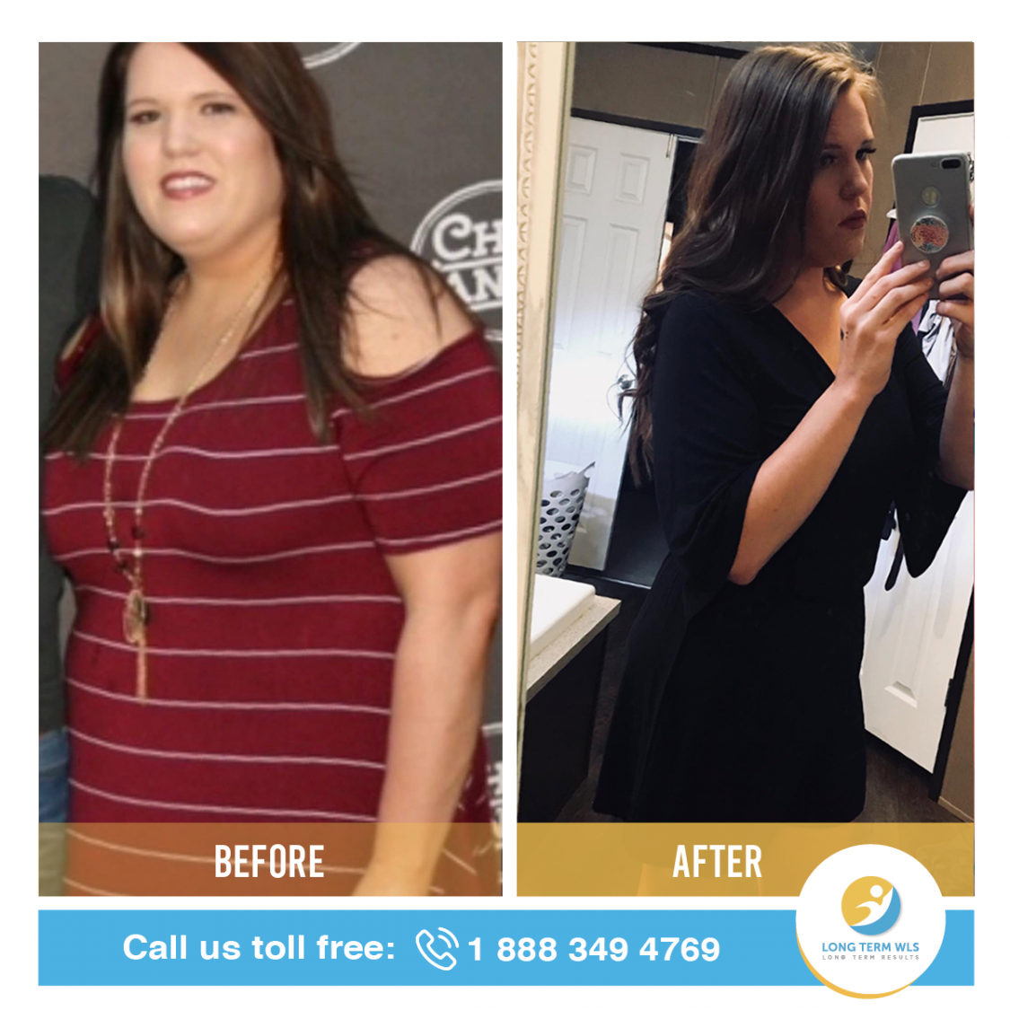 WLS Before and After Pictures Long Term WLS / VSG